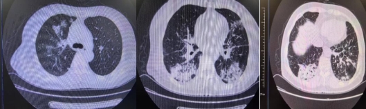 患者入院時胸部CT